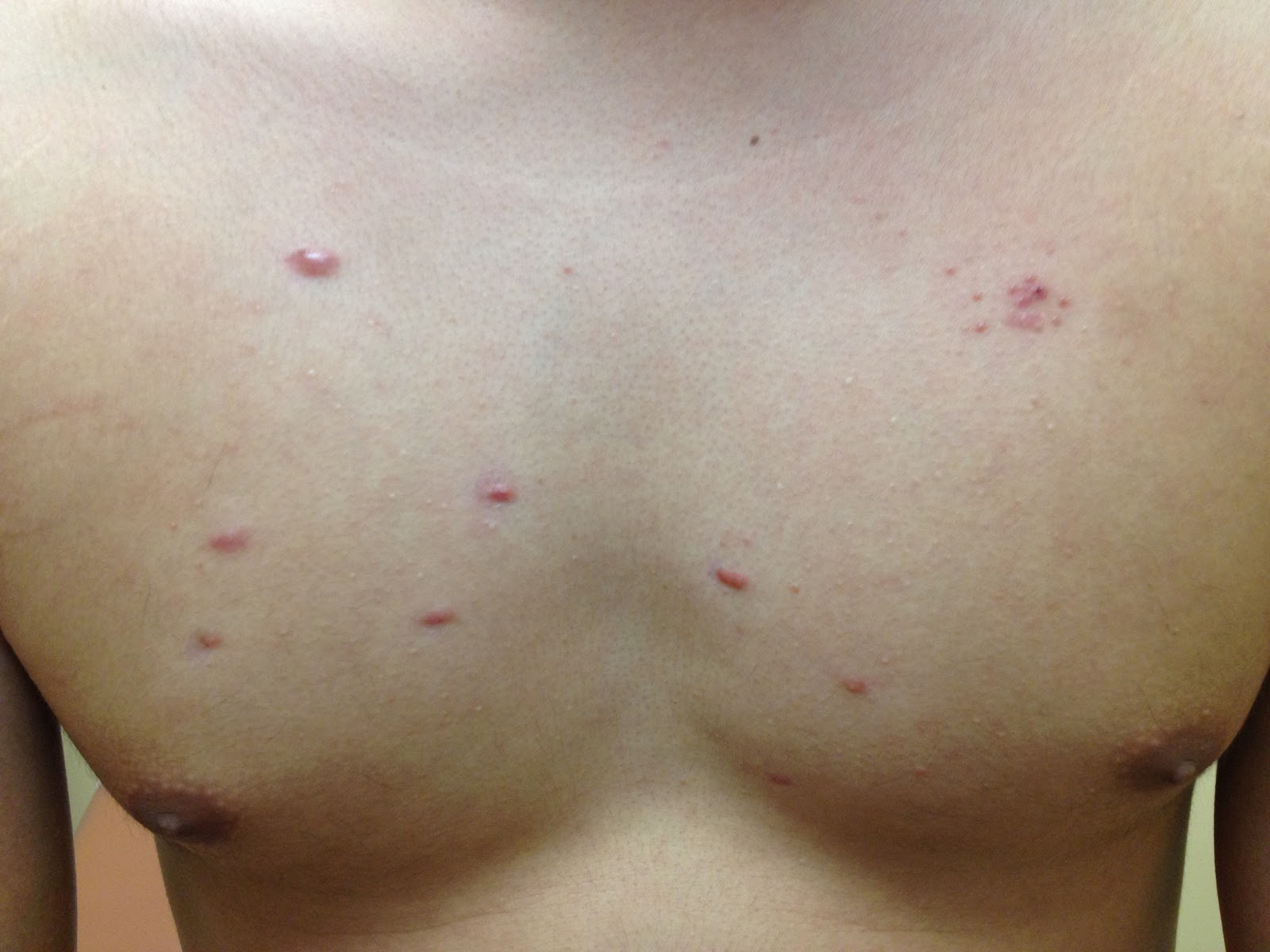 white acne scars on chest