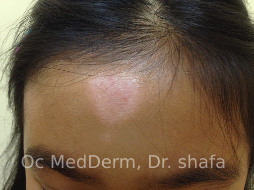 Skin Discoloration Treatment | Irvine & Orange County | OC MedDerm