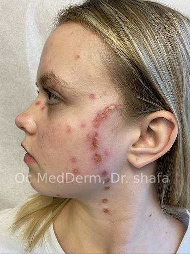 Shingles Treatment In Irvine CA Same Day Care OC MedDerm