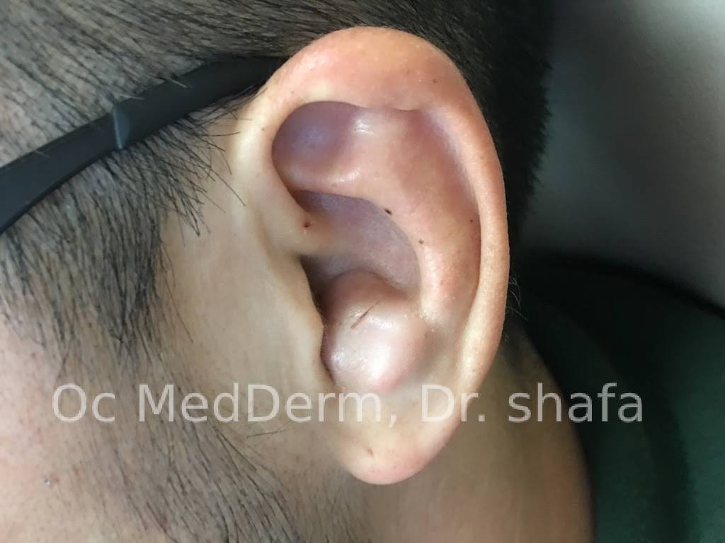 Ear Lump Removal Correction Irvineskin Orange County