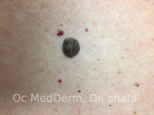 cancerous black moles