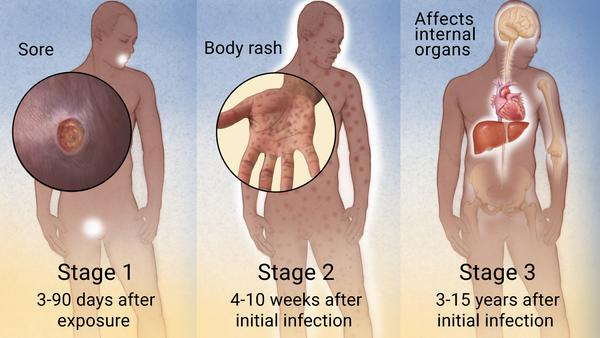 Syphilis Cause, Symptoms Treatment Orange City | Irvine Skin