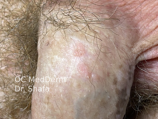 Female Genital Skin Conditions, Dermatology