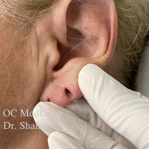 Ear Surgeries, Cosmetic Treatment  Irvine & Orange County Dermatology