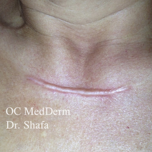 Keloid Treatment Irvine & Orange County, CA OC MedDerm Dermatology