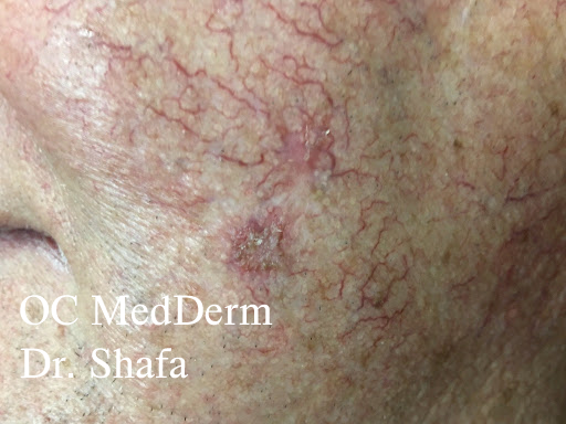 spider veins on face treatment at home