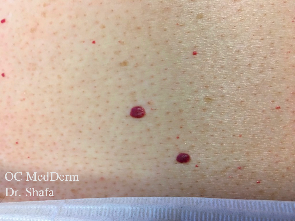 Broken Capillaries & Spider Vein Removal OC MedDerm Dermatology