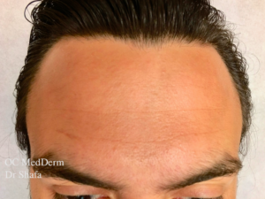Dysport or Botox treatment Irvine Dermatology