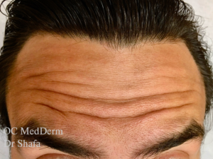 wrinkles on forehead with Dysport or Botox treatment Dermatology