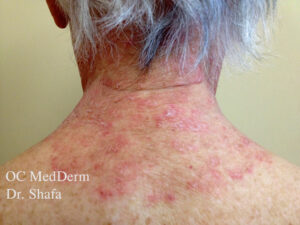 Eczema Treatment Irvine Before