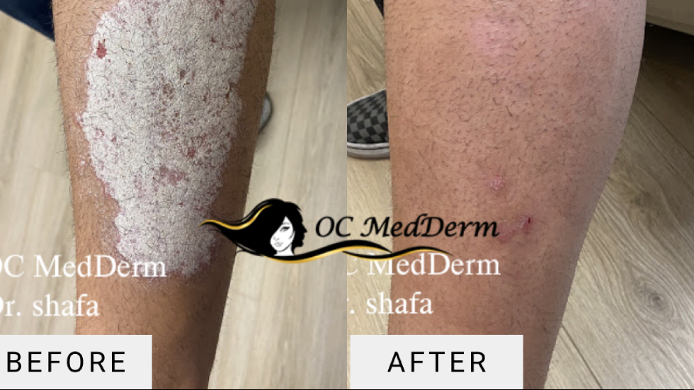 Personalized psoriasis Treatment with Dr. Shafa, Dermatology in Irvine CA