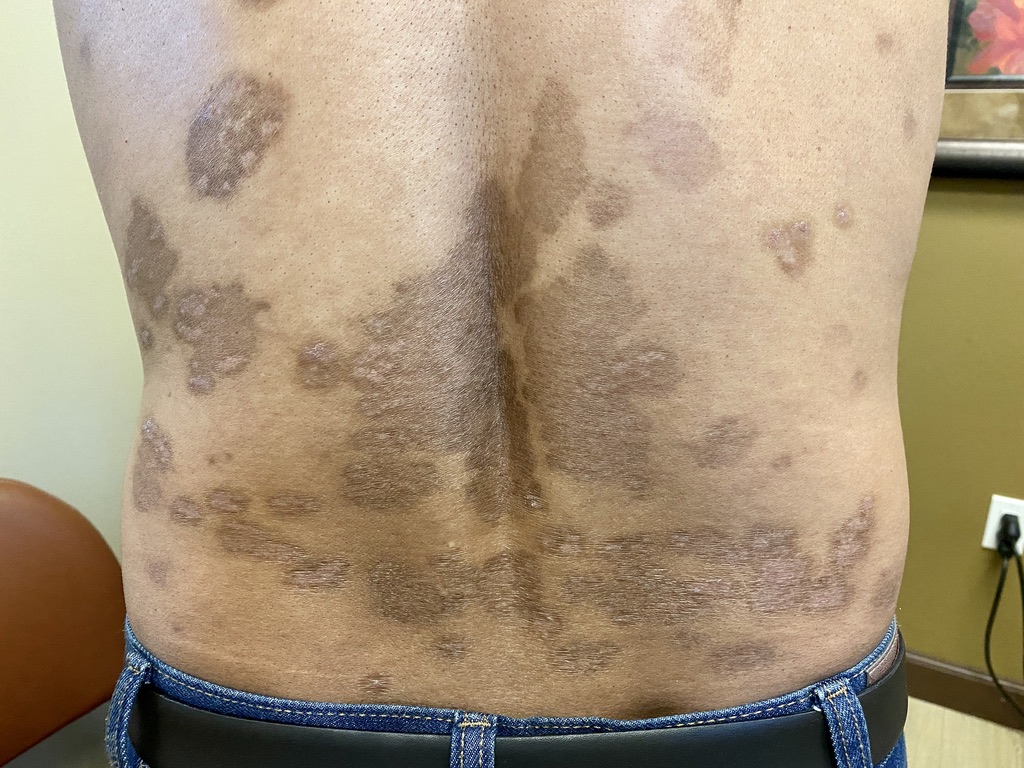 Psoriasis after treatment on lower back at OC MedDerm Irvine and Orange County, CA.