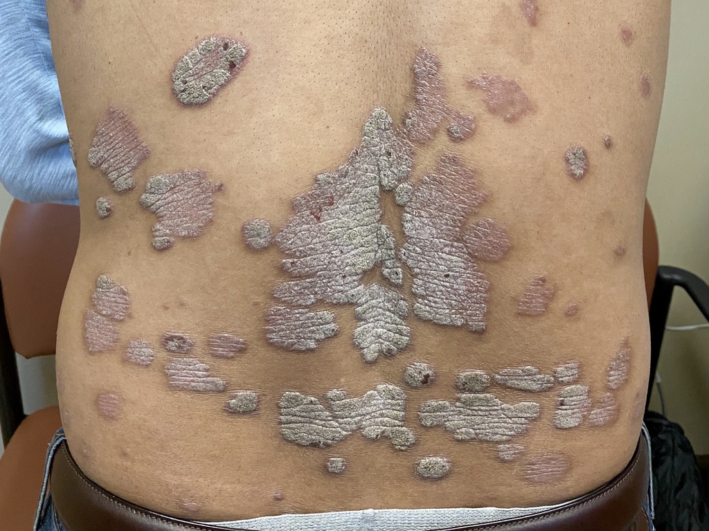 Psoriasis before treatment on lower back at OC MedDerm Irvine and Orange County, CA.