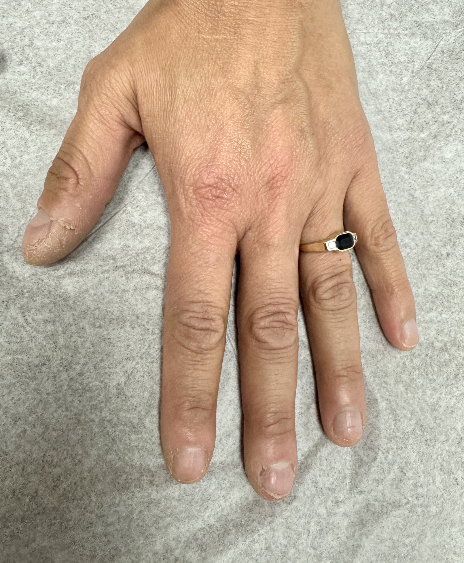 Improved nail psoriasis after treatment at OC MedDerm Irvine, CA