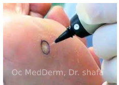 How is Mole Removal Done?