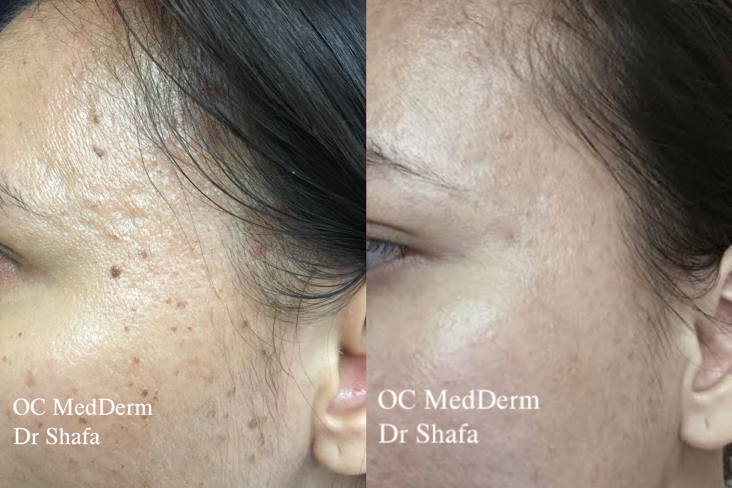 How to Remove Lumps and Bumps?