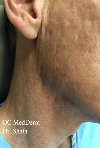 Acne Scars & Pitted Skin Before Treatment In Irvine CA