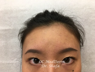 After Accutane Acne Treatment at OC MedDerm