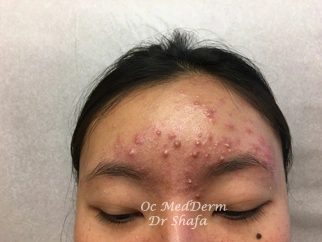 Before Accutane Acne Treatment at OC MedDerm