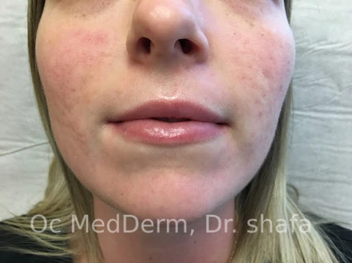 After Accutane Acne Treatment In Irvine, CA At OC MedDerm