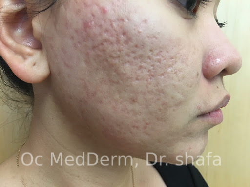 After Accutane Acne Treatment In Irvine, CA At OC MedDerm