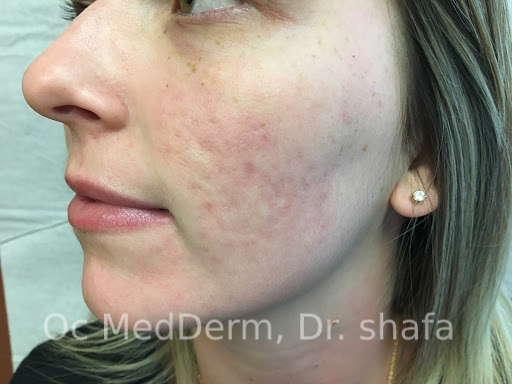 After Accutane Acne Treatment In Irvine, CA At OC MedDerm