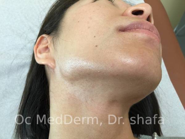 After Accutane Acne Treatment In Irvine, CA At OC MedDerm
