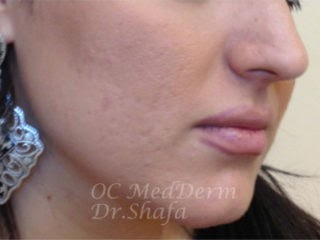 After Accutane Acne Treatment In Irvine, CA At OC MedDerm