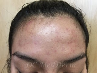 After Accutane Acne Treatment In Irvine, CA At OC MedDerm