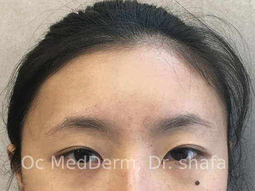 After Accutane Acne Treatment In Irvine, CA At OC MedDerm