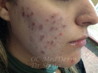 Before Accutane Acne Treatment In Irvine, CA At OC MedDerm