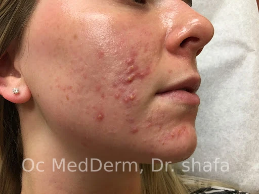 Before Accutane Acne Treatment In Irvine, CA At OC MedDerm