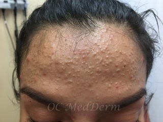 Before Accutane Acne Treatment In Irvine, CA At OC MedDerm