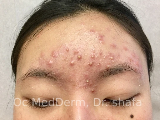 Before Accutane Acne Treatment In Irvine, CA At OC MedDerm