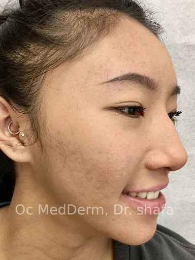 After Accutane Acne Treatment In Irvine, CA At OC MedDerm