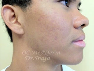After Accutane Acne Treatment In Irvine, CA At OC MedDerm