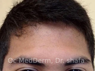 After Accutane Acne Treatment In Irvine, CA At OC MedDerm