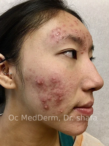 Before Accutane Acne Treatment In Irvine, CA At OC MedDerm