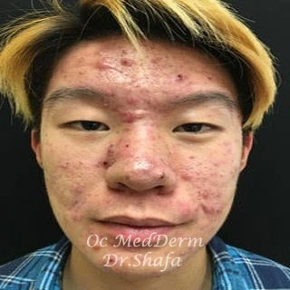Before Accutane Acne Treatment In Irvine, CA At OC MedDerm
