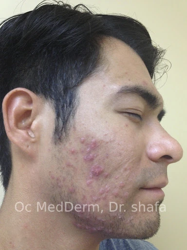 Before Accutane Acne Treatment In Irvine, CA At OC MedDerm