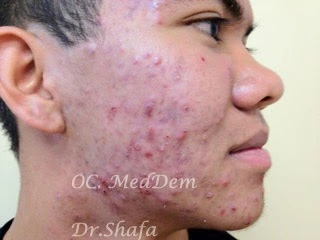 Before Accutane Acne Treatment In Irvine, CA At OC MedDerm