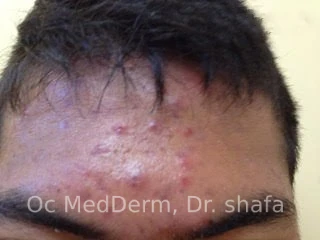 Before Accutane Acne Treatment In Irvine, CA At OC MedDerm