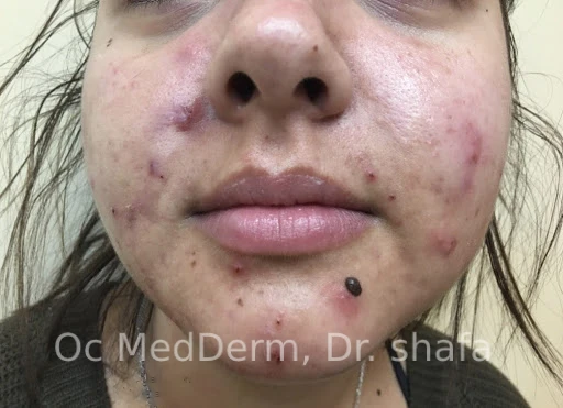 Before Accutane Acne Treatment In Irvine, CA At OC MedDerm