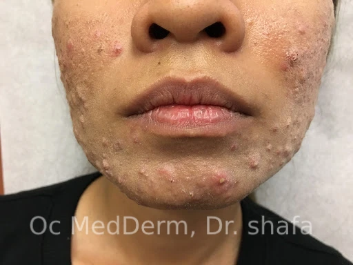 Before Accutane Acne Treatment In Irvine, CA At OC MedDerm