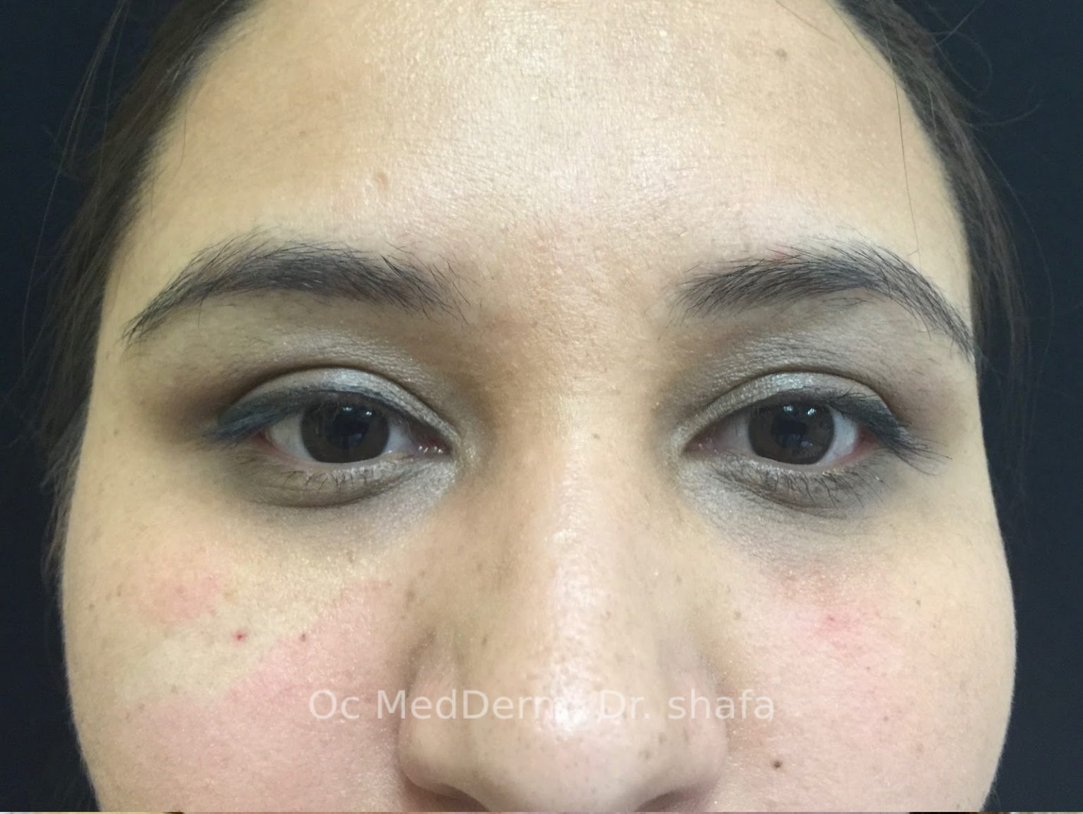 After Dark Circle Under Eye Correction with Fillers in Irvine, CA