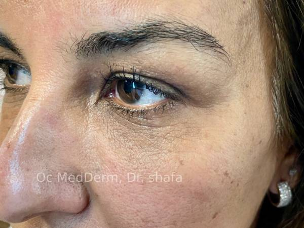 After Dark Circle Under Eye Correction with Fillers in Irvine, CA