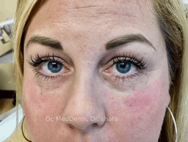 After Dark Circle Under Eye Correction with Fillers in Irvine, CA