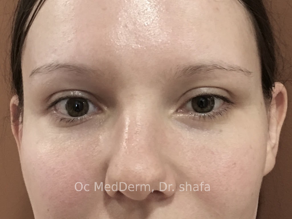 After Dark Circle Under Eye Correction with Fillers in Orange County