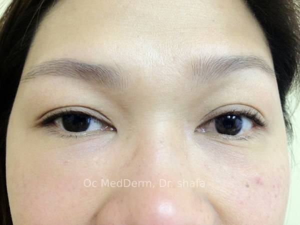 After Dark Circle Under Eye Correction with Fillers in Orange County