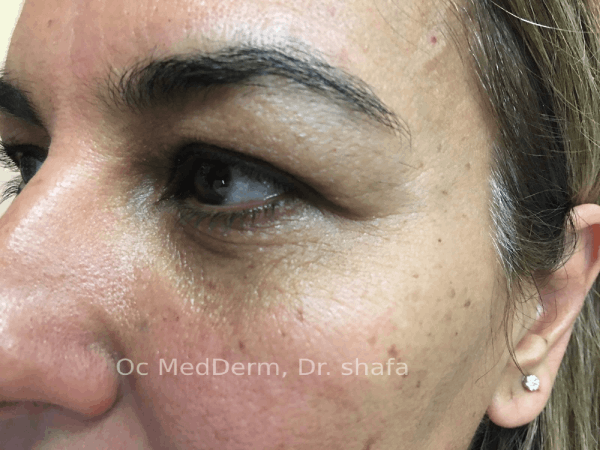 Before Dark Circle Under Eye Correction with Fillers in Irvine, CA